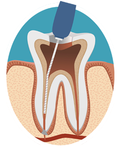 Root Canal Therapy | Langworthy Family Dental