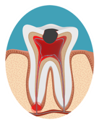 stage1-root-canal-dubuque.png stage1-root-canal-dubuque.png